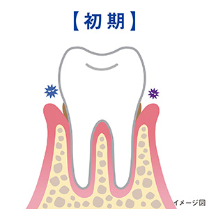 赤みや腫れ、出血、口臭が生じる