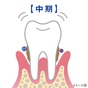 骨が徐々に溶け始め、歯ぐきが下がる