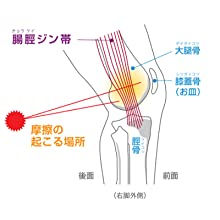 腸脛靭帯炎