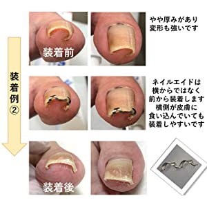 ネイルエイドの装着例２