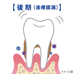 さらに骨が溶け、歯がグラグラする