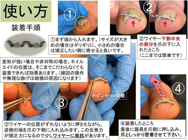 ネイルエイド 16㎜ 巻き爪 矯正 自分で 巻きづめ ワイヤー クリップ - 画像 (4)